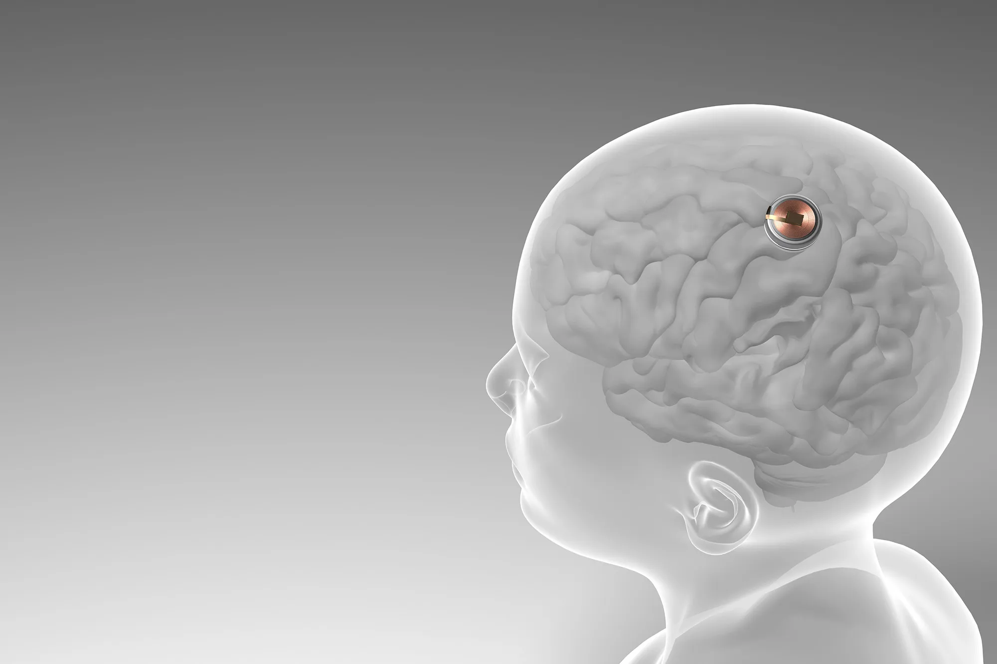 Neuralink’s Pioneering Patient Stays Optimistic Despite Challenges in Brain-Implant Trial